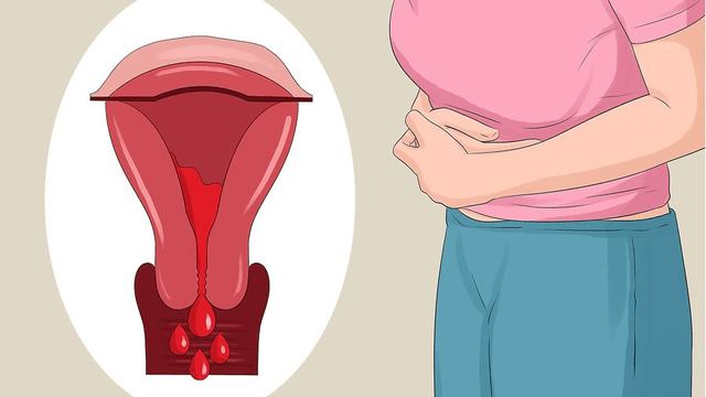 Giống như cổ tử cung, vô sinh có thể xảy ra do cấu trúc của tử cung gặp vấn đề và những khối u, mô sẹo và các kết dính của lần phẫu thuật trước